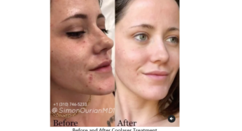 Dr. Simon Ourian Presents New And Effective Treatment For Melasma